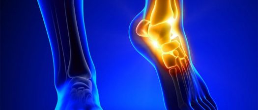 Understanding and Preventing Tendonitis